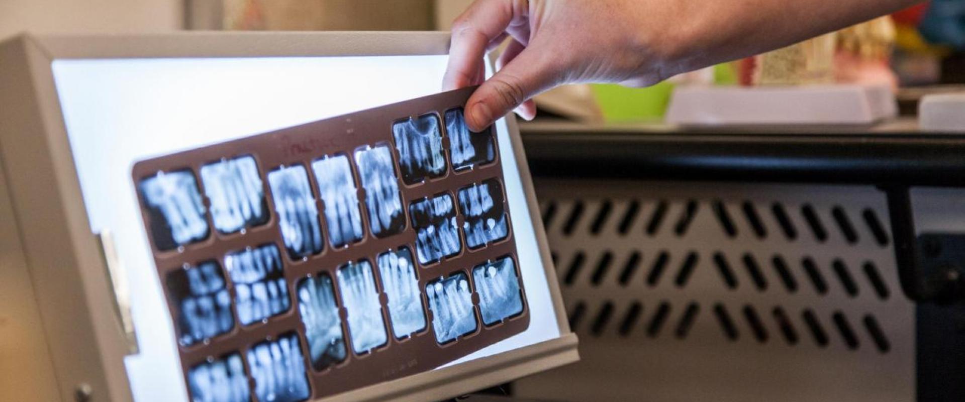 Dental x-ray on a viewing screen